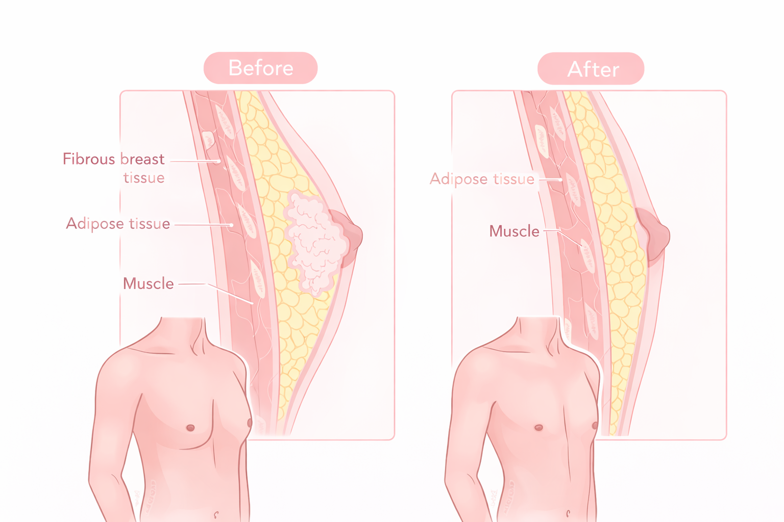 Man showing gynecomastia chest enlargement symptom