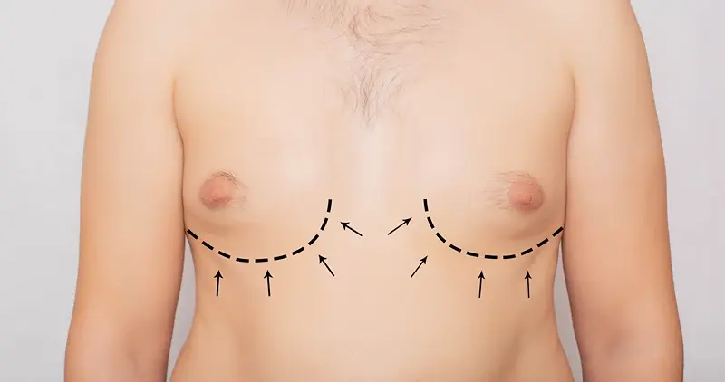 Surgical markings for gynecomastia male breast reduction procedure