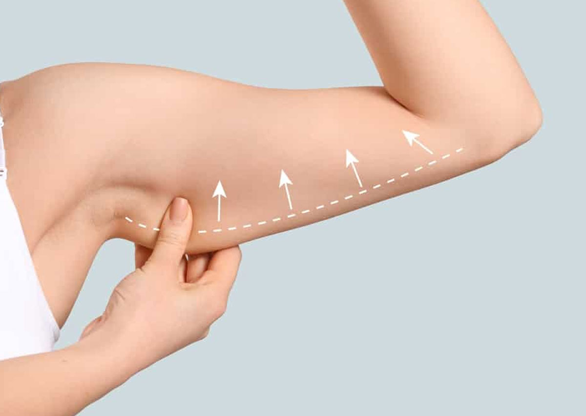 Liposuction arm contouring