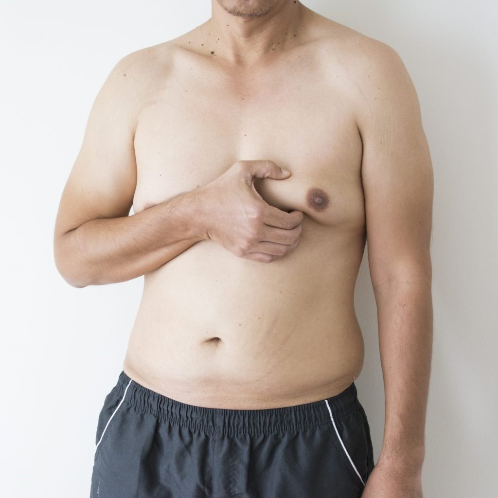 Gynecomastia before and after comparison illustration