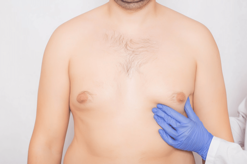 Gynecomastia before and after — flatter, masculine chest