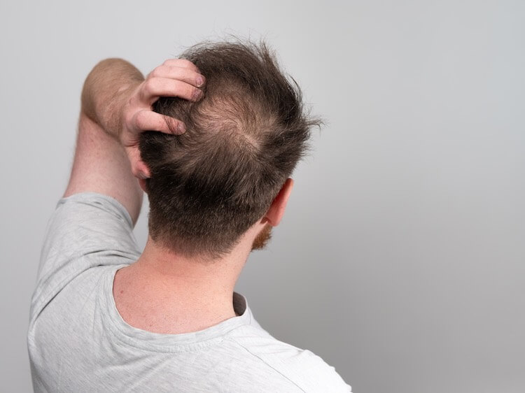 hair loss treatment