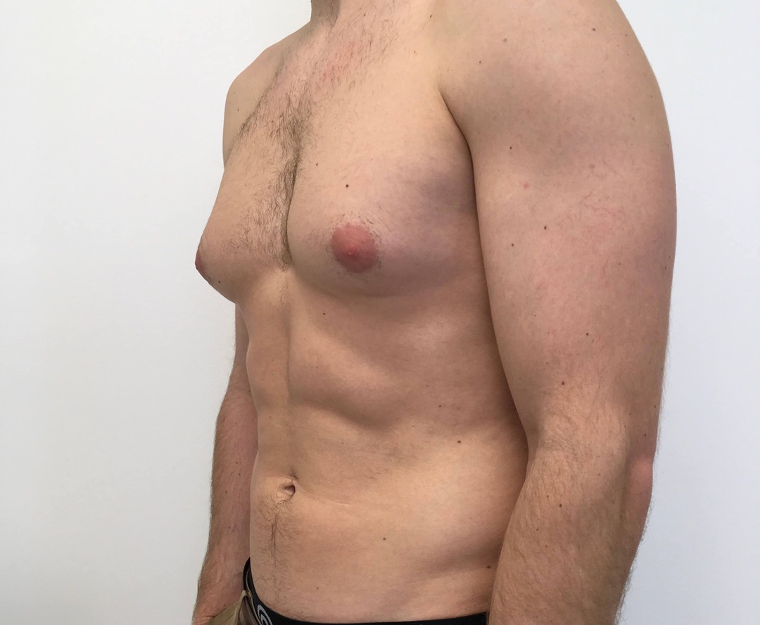 Doctor examining gynecomastia patient
